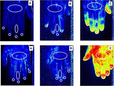 Innovations in the Assessment of Primary and Secondary Raynaud’s Phenomenon